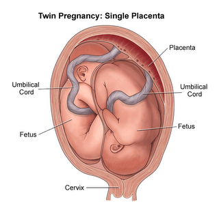 single placenta